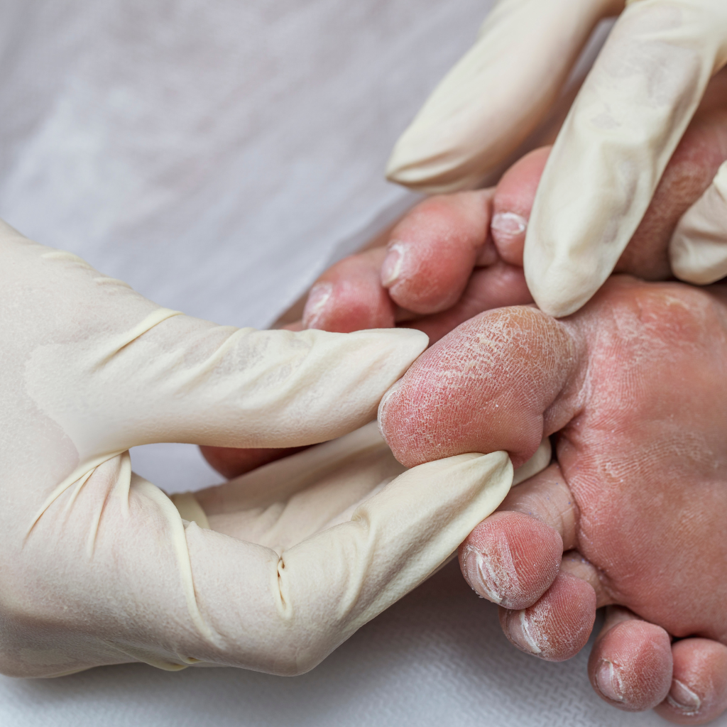 diabetic foot cleaning at home